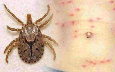 ସୁନ୍ଦରଗଡ଼ରେ ଚିହ୍ନଟ ୬ଜଣ ନୂଆ ସ୍କ୍ରବ୍ ଟାଇଫସ୍‌ ରୋଗୀ : ସଂଖ୍ୟା ୨୦୬କୁ ବୃଦ୍ଧି